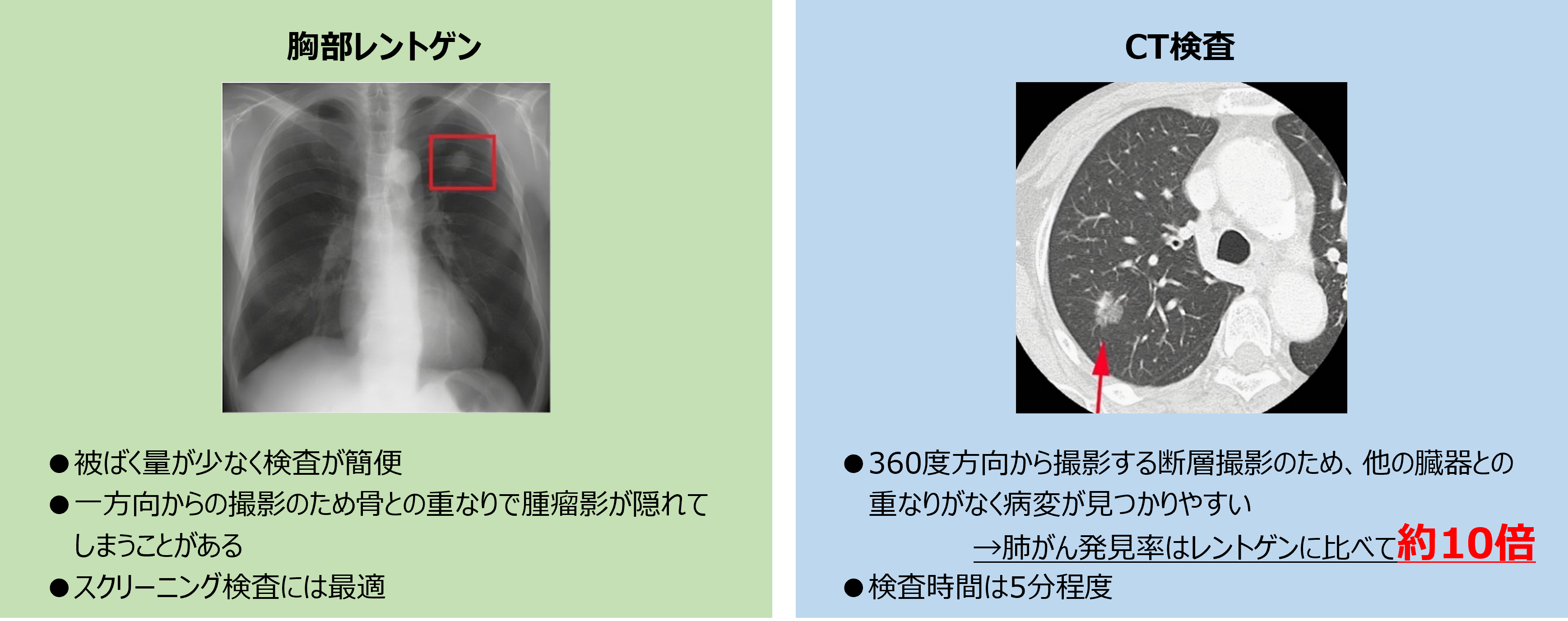 CT スキャンは肺がんを正確に検出できますか? - 健康百科事典